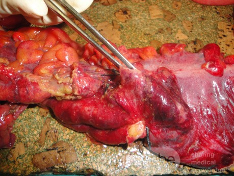 Multiple Rectal Ulcers (80 of 110)