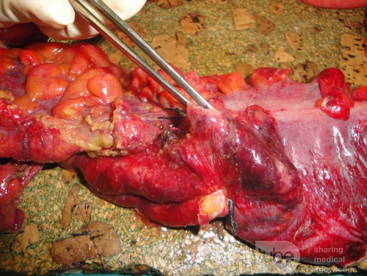 Multiple Rectal Ulcers (80 of 110)