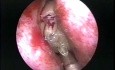 On The Origin of the Application of the Arthoscopic Shaver in Endoscopic Sinus Surgery (Historical Video)