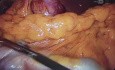 Radical subtotal gastrectomy D2 by distal gastric cancer