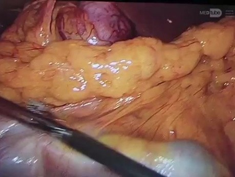 Radical subtotal gastrectomy D2 by distal gastric cancer