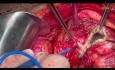 Ovarian Cancer Cytoreductive Surgery. Unedited version. Part III Pelvis.