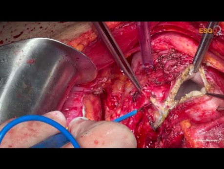 Ovarian Cancer Cytoreductive Surgery. Unedited version. Part III Pelvis.
