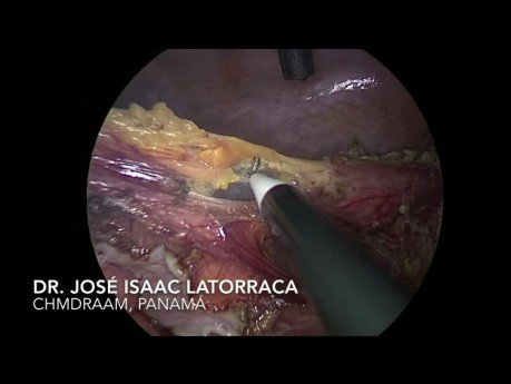 Laparoscopic Hartmann's Operation in Sigmoid Colon Volvulus