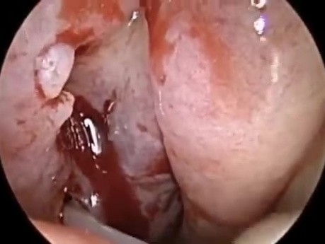 Endoscopic Drainage of Hypoplastic Maxillary Sinus
