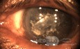 Black Cataract
