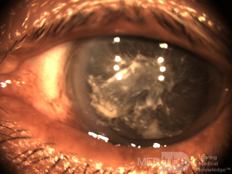 Black Cataract