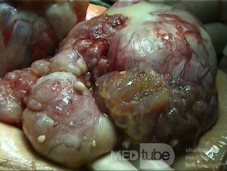 Cancer Ovary
