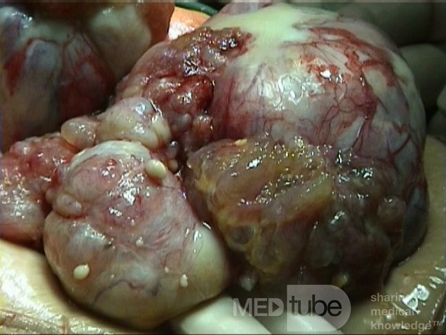 Cancer Ovary