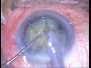 Phacoemulsification - Hard Case