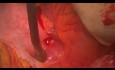 Using Off Pump Technique for Very Low LVEF Patients to Revascularize and Perform SVR 