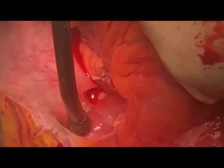 Using Off Pump Technique for Very Low LVEF Patients to Revascularize and Perform SVR 