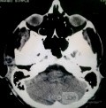 Acute Spontaneous Subdural Hemorrhage in the Subdural Space