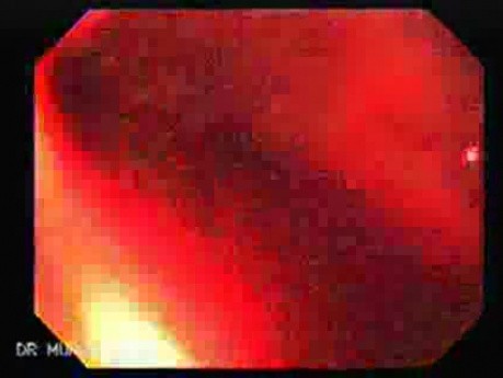 Upper Gastrointestinal Bleeding - Washing with Water