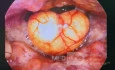 An Epiglottic Inclusion Cyst