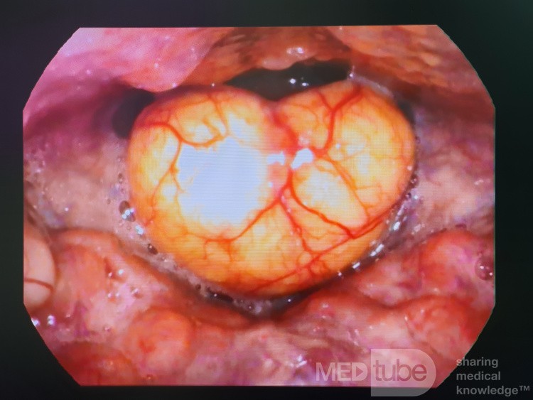 An Epiglottic Inclusion Cyst