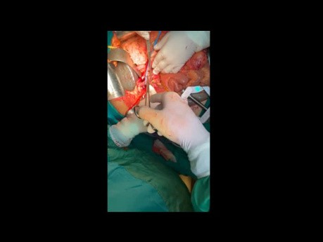 Emergency Pancreatoduodenectomy for Massive Gastro-Intestinal Hemorrhage Through The Duct of Wirsung
