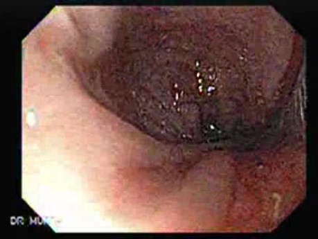 Adenocarcinoma Of The Cardia - Recapture Of The Evolution Stent