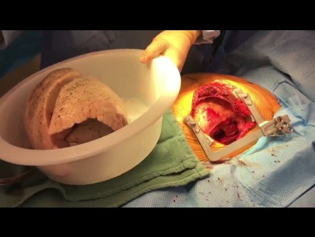 Unilateral Lung Transplantation with Antrolateral Thoracotomy