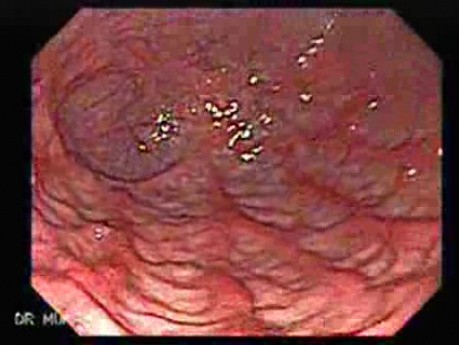 Acute Gastritis. Reddened Gastric Folds
