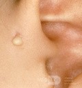 Infected Preauricular Sinus [left]