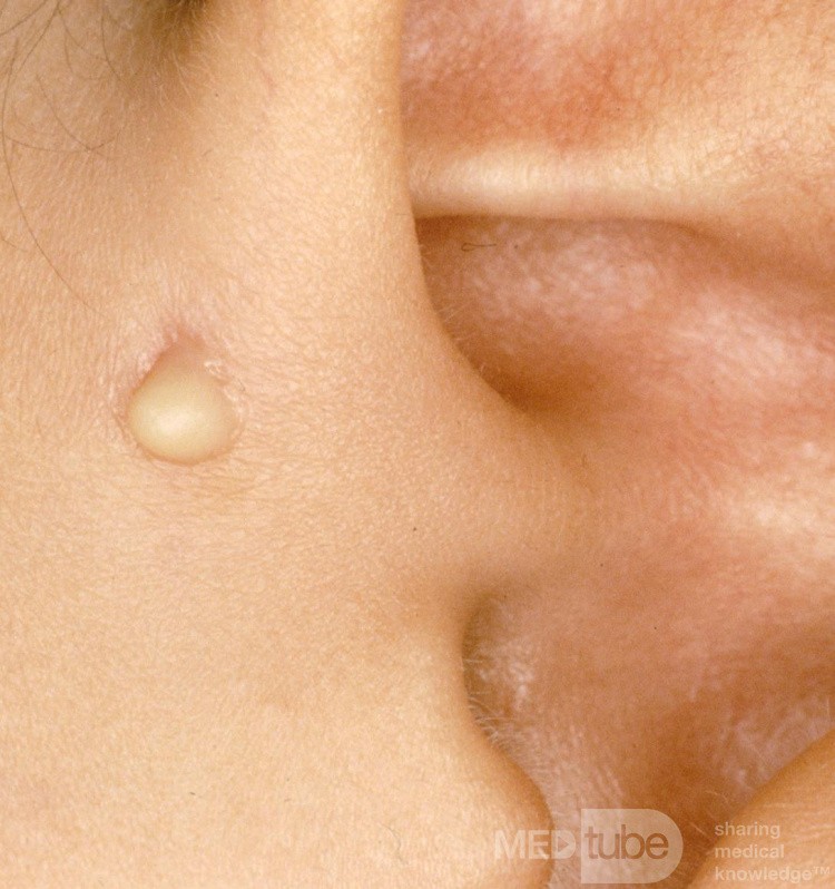 Infected Preauricular Sinus [left]