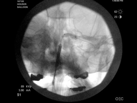 Baloon Sinuplasty 