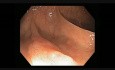 Colonoscopy Channel - Serrated Adenoma with Intramucosal Cancer