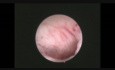 H-sil Endocervico