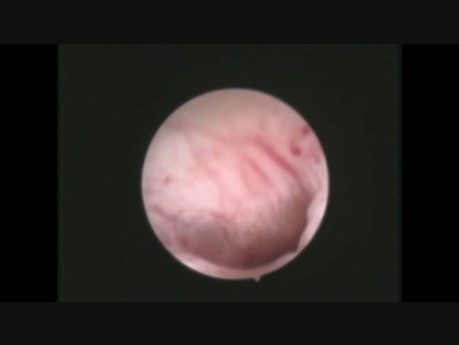 H-sil Endocervico