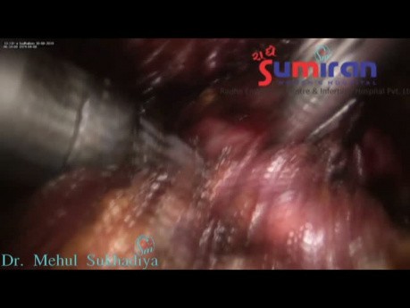 Difficult TLH in Frozen Pelvic GR-4 Endometriosis