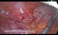 Laparoscopic Stapler Appendectomy 