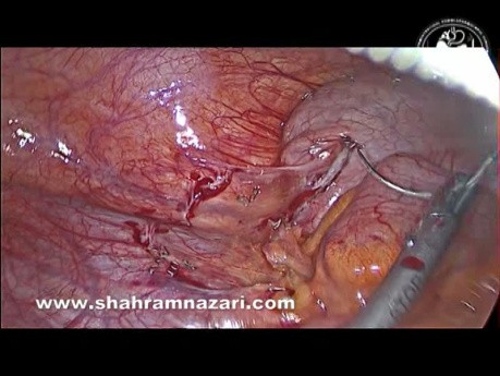 Laparoscopic Stapler Appendectomy 