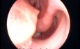 Nasal septum deviation With Septal Spur