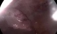 Ectopic Pregnancy
