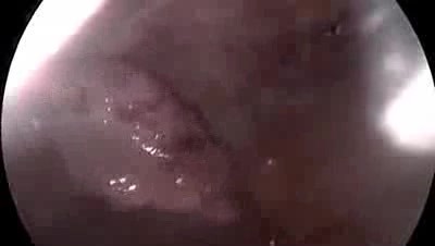 Ectopic Pregnancy