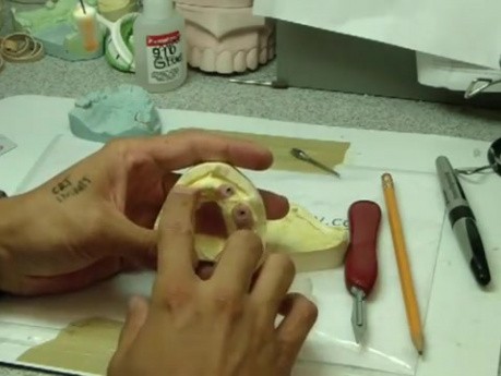 Bar Supported Maxillary Denture - Part 1 - Discussion About Treatment