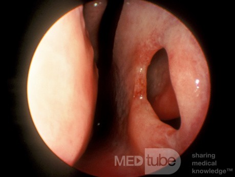 Nasal Septal Perforation