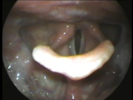 Palsy of The Vocal Cords