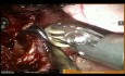 Neoadjuvant Therapy Lung Cancer