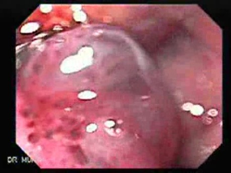 Long Standing Alcohol Abuse - Large Varix Under Magnifying View
