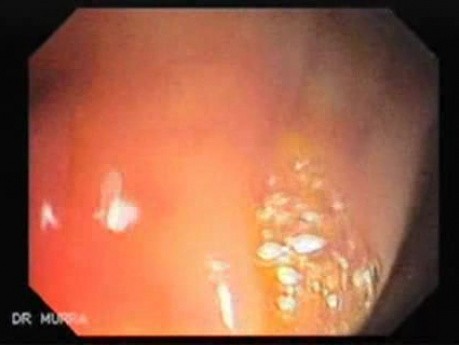 Trichuris Trichuris (whipworm) (2 of 4)