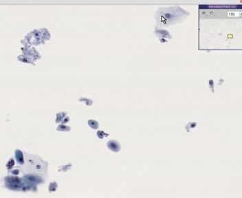 Cervix - Atrophy