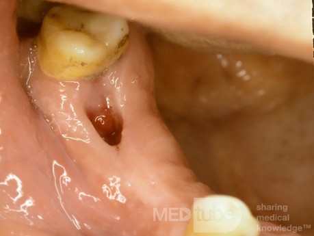Oroantral Fistula