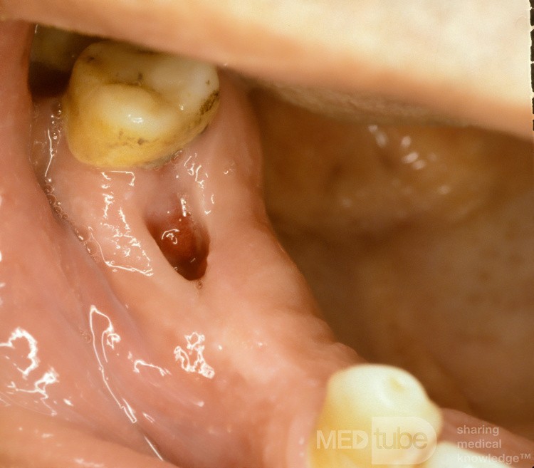 Oroantral Fistula
