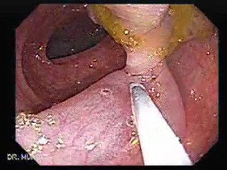 Colonoscopic Polypectomy (7 of 29)