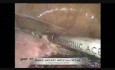 Laparoscopic Low Anterior Resection and Hysterectomy