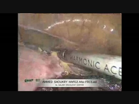 Laparoscopic Low Anterior Resection and Hysterectomy