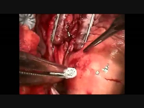 Bypass Surgery on a Beating Heart