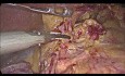 Laparoscopic Distal Gastrectomy with D2 Lymph Node Dissection for Cancer 